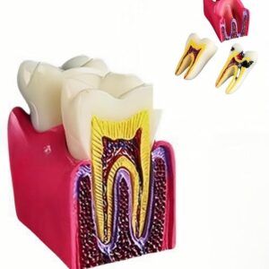 6 adet Diş Çürüğü Öğretim Modeli